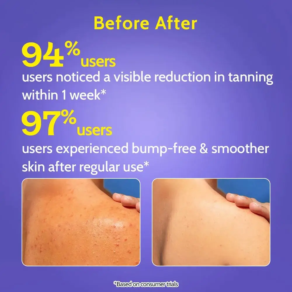 Chemist at Play Exfoliating Body Wash Bumpy Skin Before After